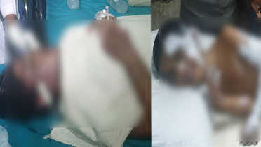 সাবেক স্বামীর এসিডে ঝলসে গেল স্ত্রী-ছেলের শরীর