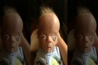 বেঁচে থেকেও মৃতপ্রায়, তার নামেই বিরল রোগের নামকরণ