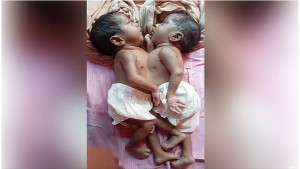  জোড়া লাগা সেই যমজ শিশু দুটির মৃত্যু হয়েছে