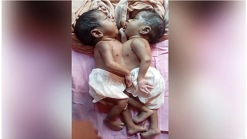  জোড়া লাগা সেই যমজ শিশু দুটির মৃত্যু হয়েছে
