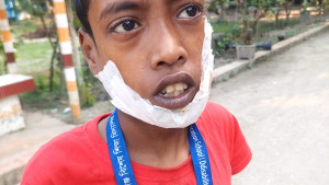 বড় ভাইয়ের গালে কামড় দিয়ে মাংস তুলে নিল ছোট ভাই