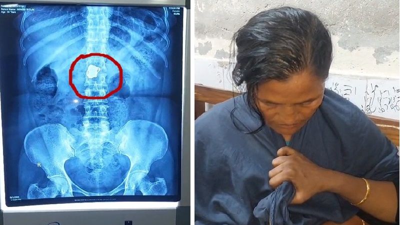 রোগী সেজে হাসপাতালে চুরি, এক্স-রেতে পেটে মিলল ২ সোনার চেইন